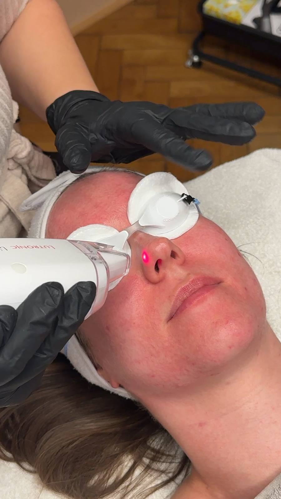Laserbehandlung an der Stirn