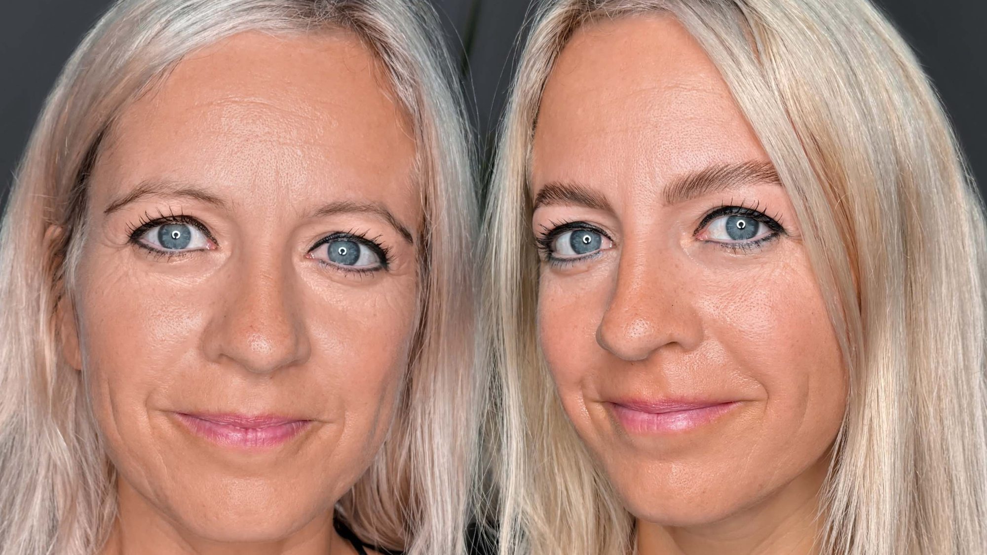 Brow Lifting, vorher und nachher