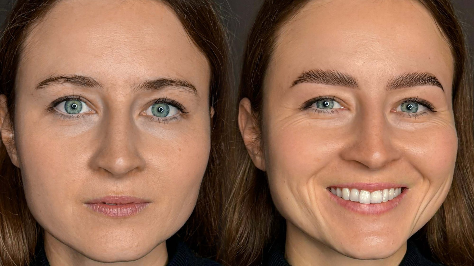 Brow Lifting, vorher und nachher