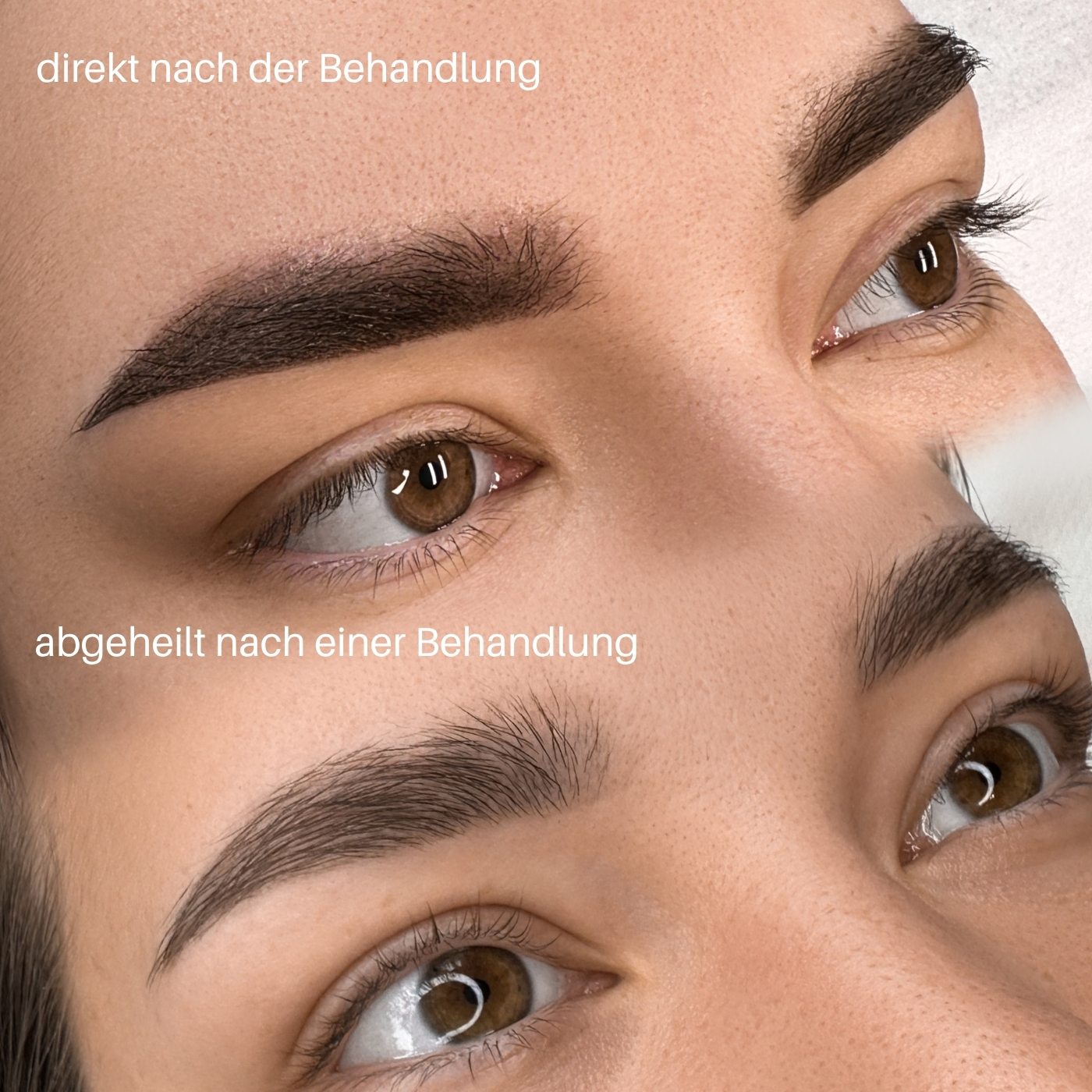 Direkt nach der Behandlung und abgeheilt