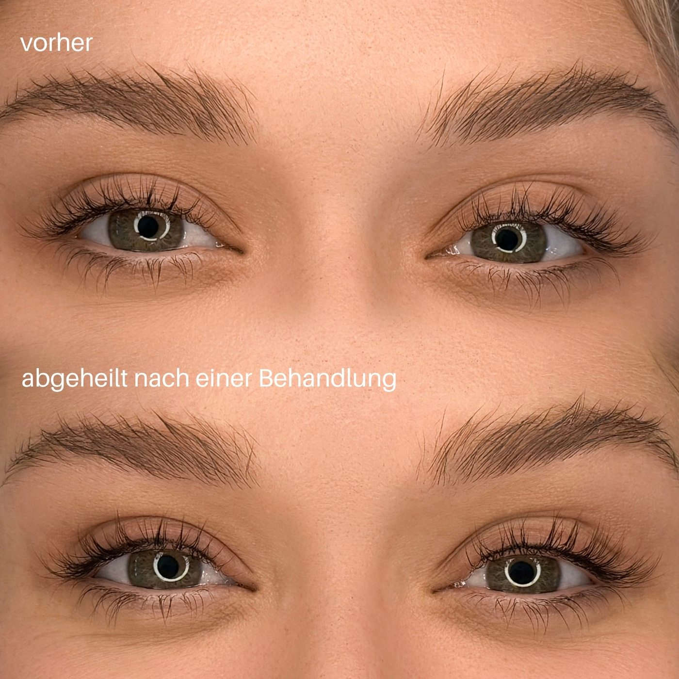 Wimpernkranzverdichtung, vorher und nachher