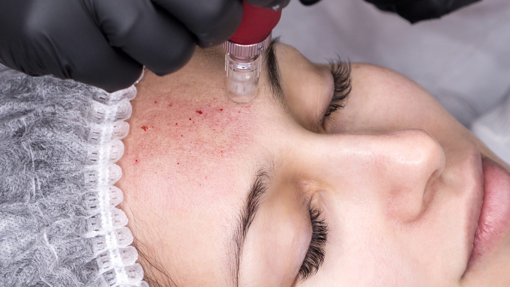 Microneedling an der Stirn