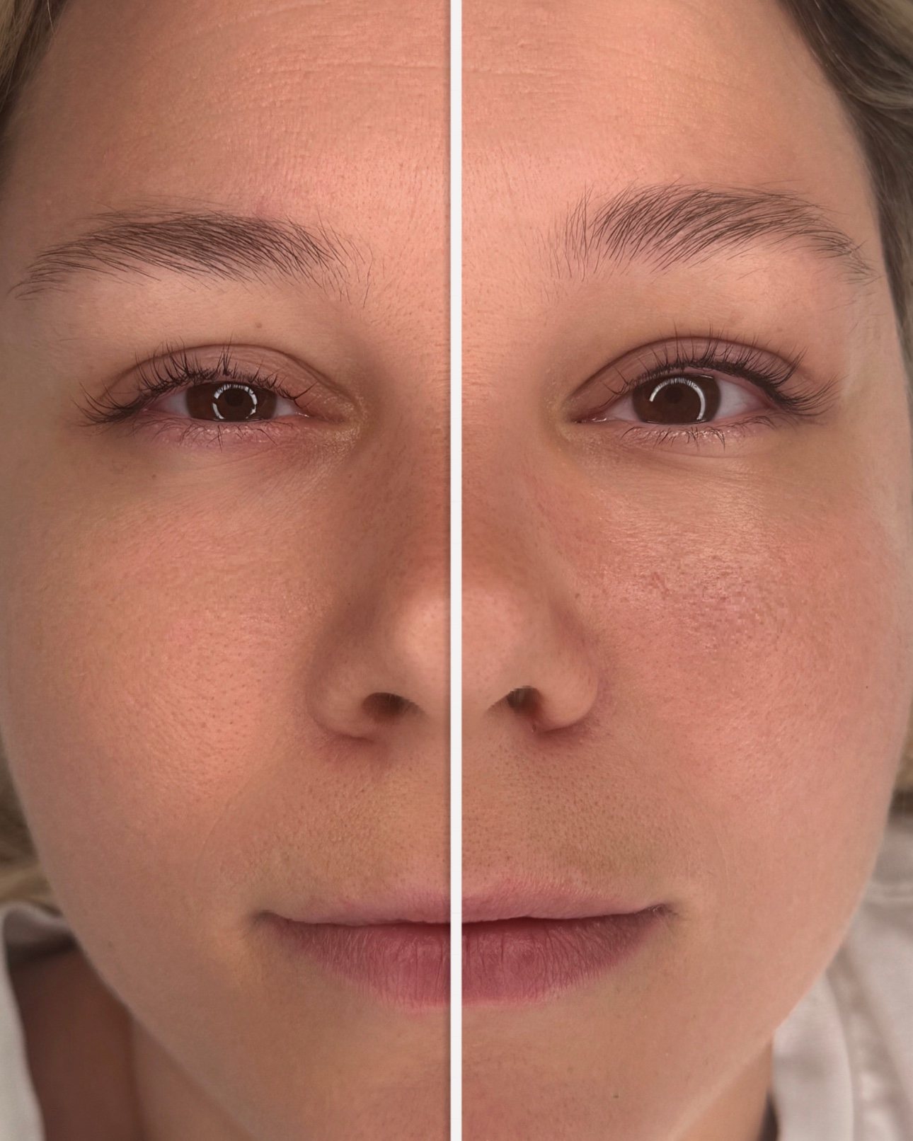 Wimpernkranzverdichtung, vorher und nachher